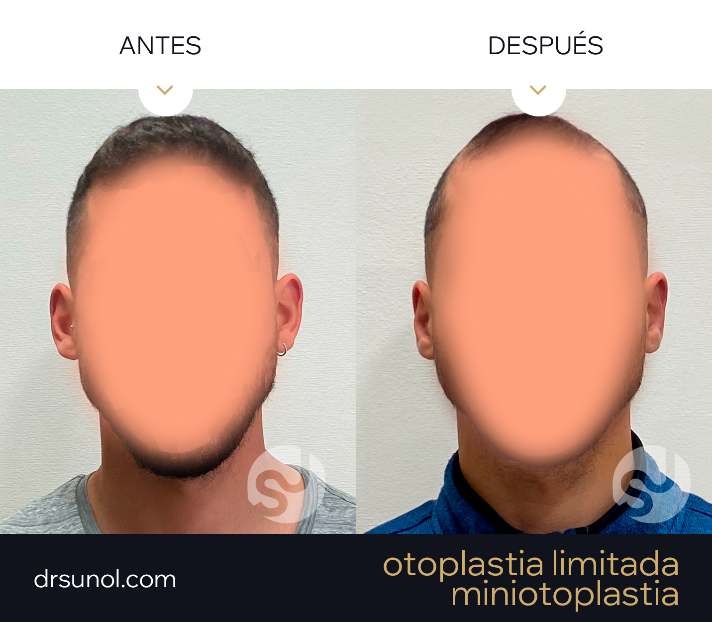 MiniOtoplastia Orejas prominentes Antes y despues MiniOtoplastia Orejas prominentes Antes y despues