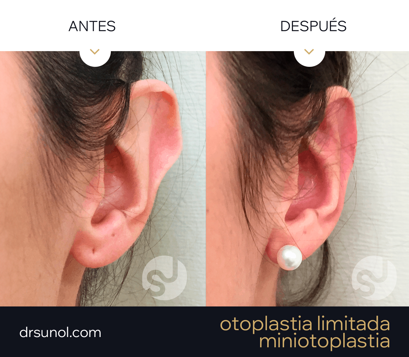 MiniOtoplastia Reduccion Tuberculo Darwin Antes y despues MiniOtoplastia Reduccion Tuberculo Darwin Antes y despues