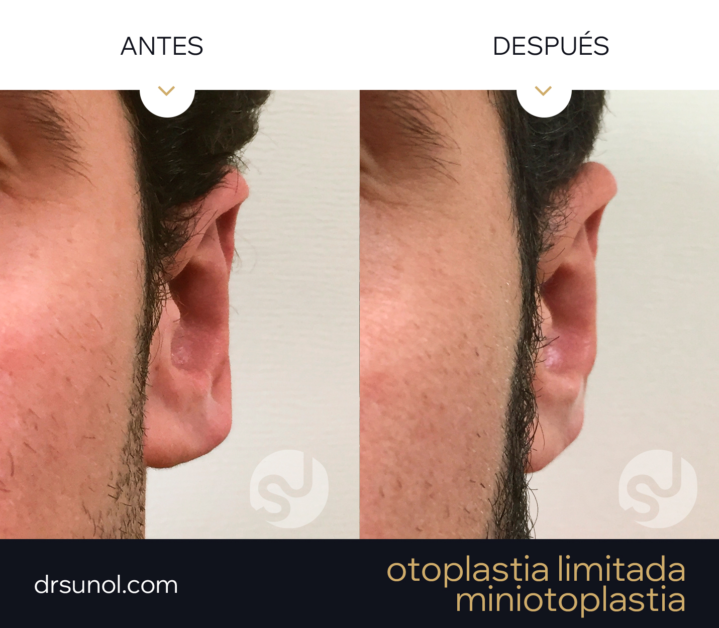 miniotoplastia antes y después miniotoplastia antes y después