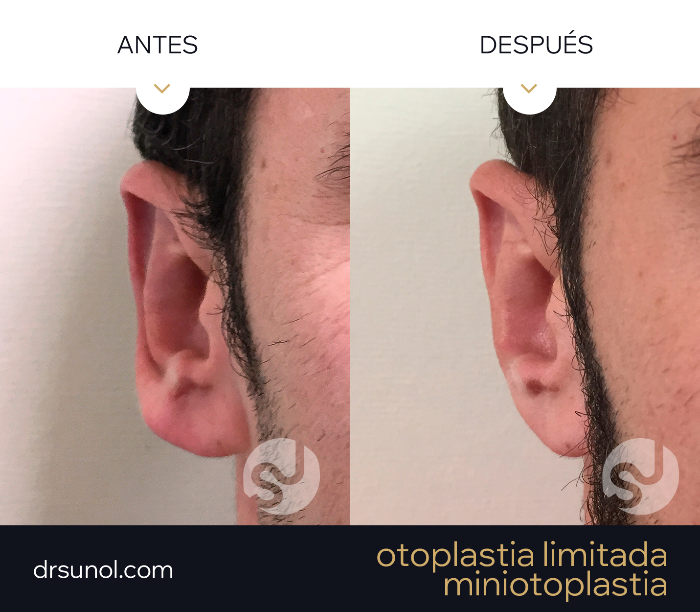 Otoplastia Limitada MiniOtoplastia Secundaria Rotacion Lobulos Antes y despues Otoplastia Limitada MiniOtoplastia Secundaria Rotacion Lobulos Antes y despues