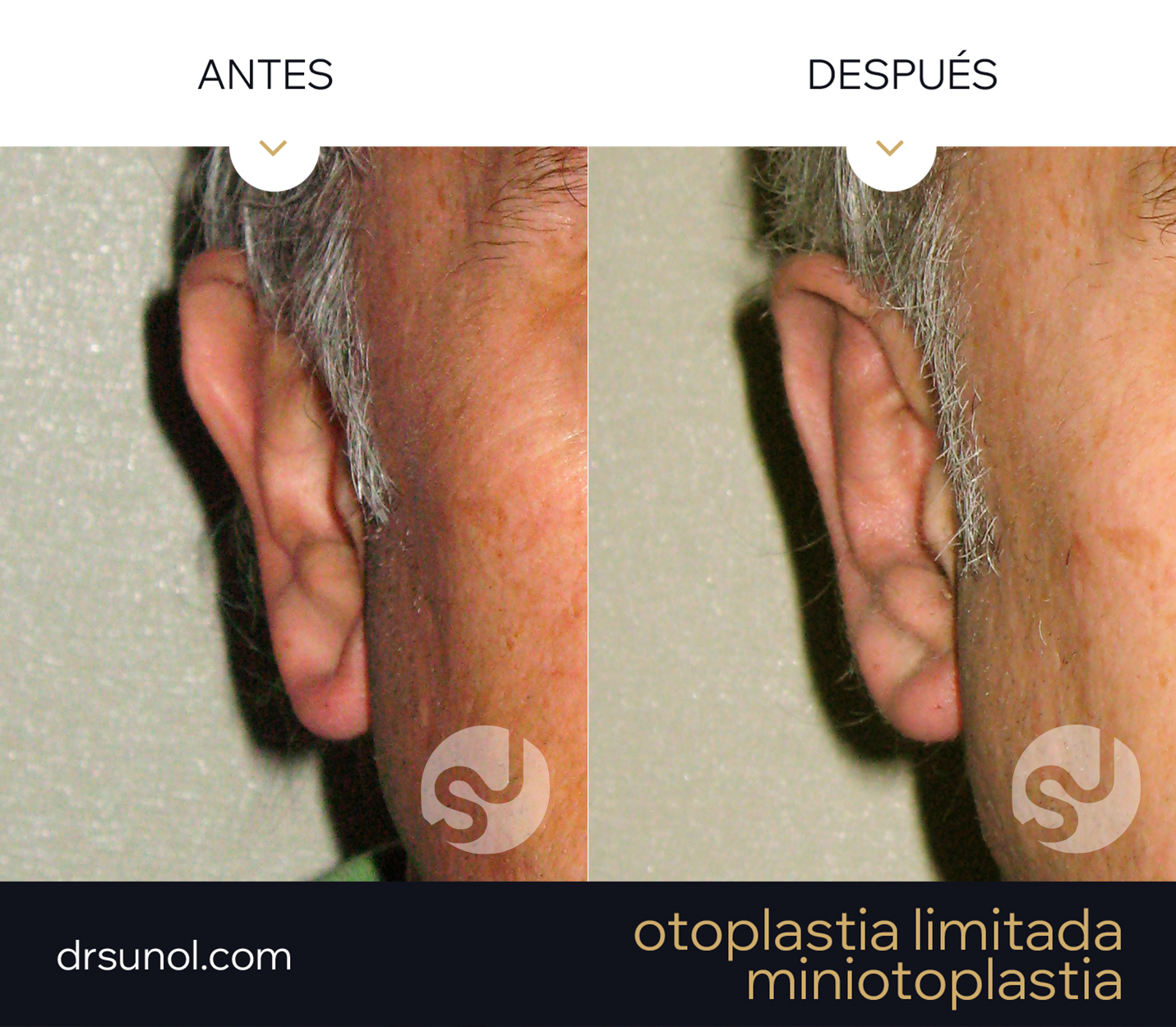 MiniOtoplastia orejas prominentes Pliegue Antehelix