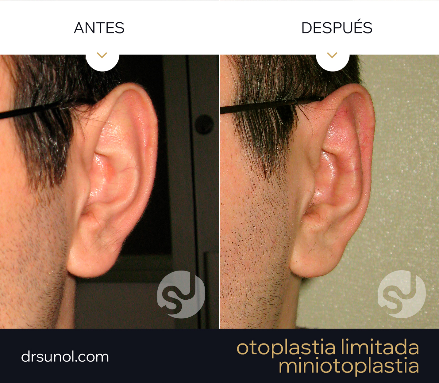 MiniOtoplastia orejas prominentes Pliegue Antehelix MiniOtoplastia orejas prominentes Pliegue Antehelix