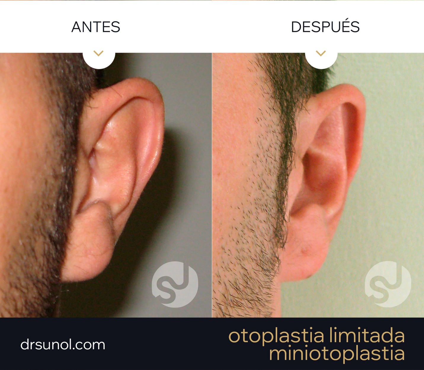 MiniOtoplastia orejas prominentes Pliegue Antehelix MiniOtoplastia orejas prominentes Pliegue Antehelix