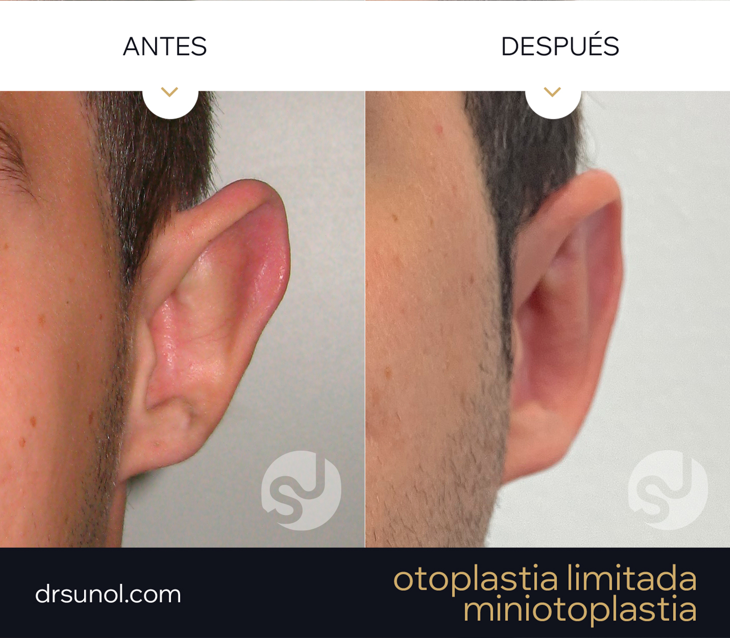 MiniOtoplastia orejas prominentes Pliegue Antehelix MiniOtoplastia orejas prominentes Pliegue Antehelix