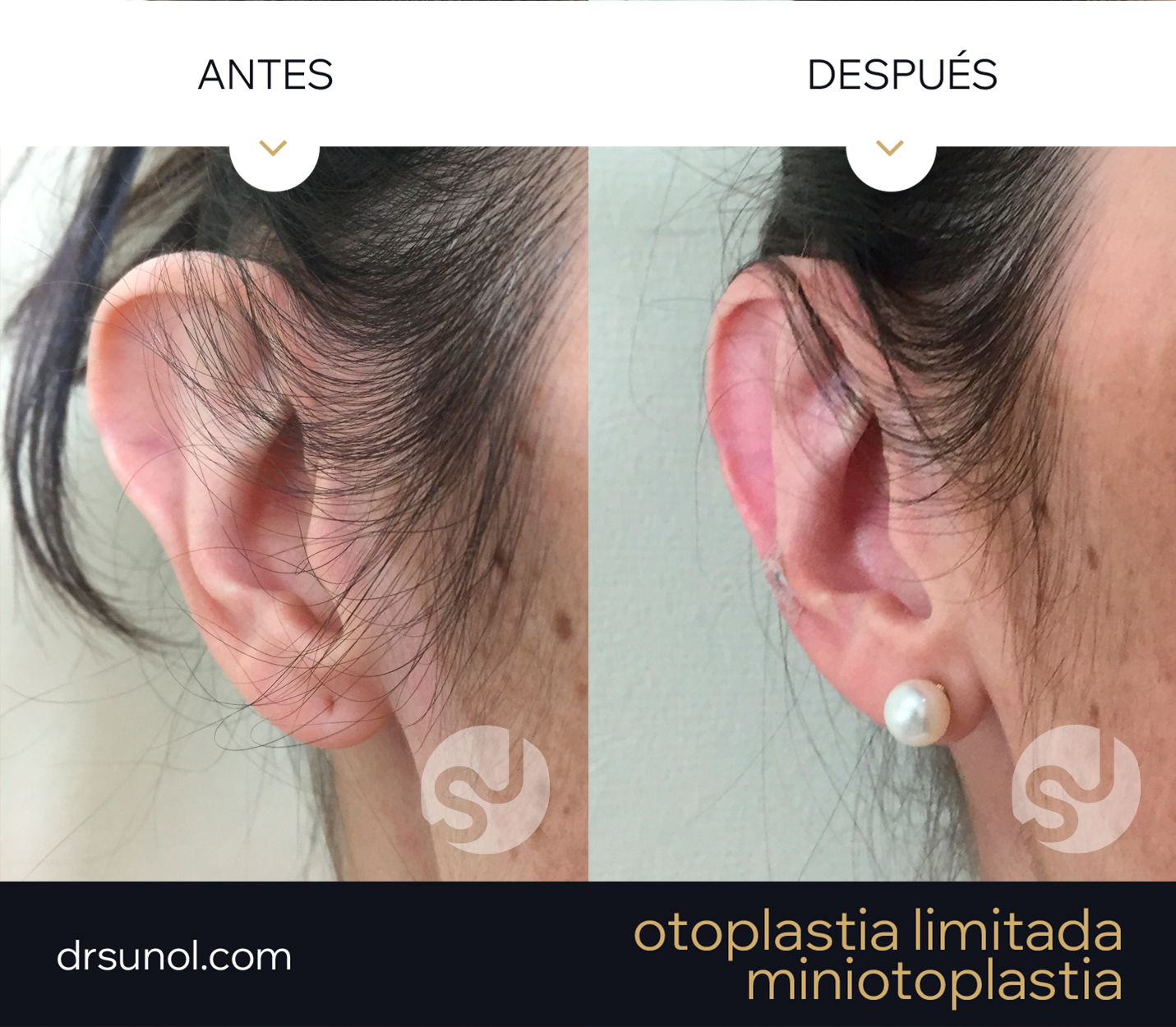 MiniOtoplastia orejas prominentes tuberculo darwin MiniOtoplastia orejas prominentes tuberculo darwin width=