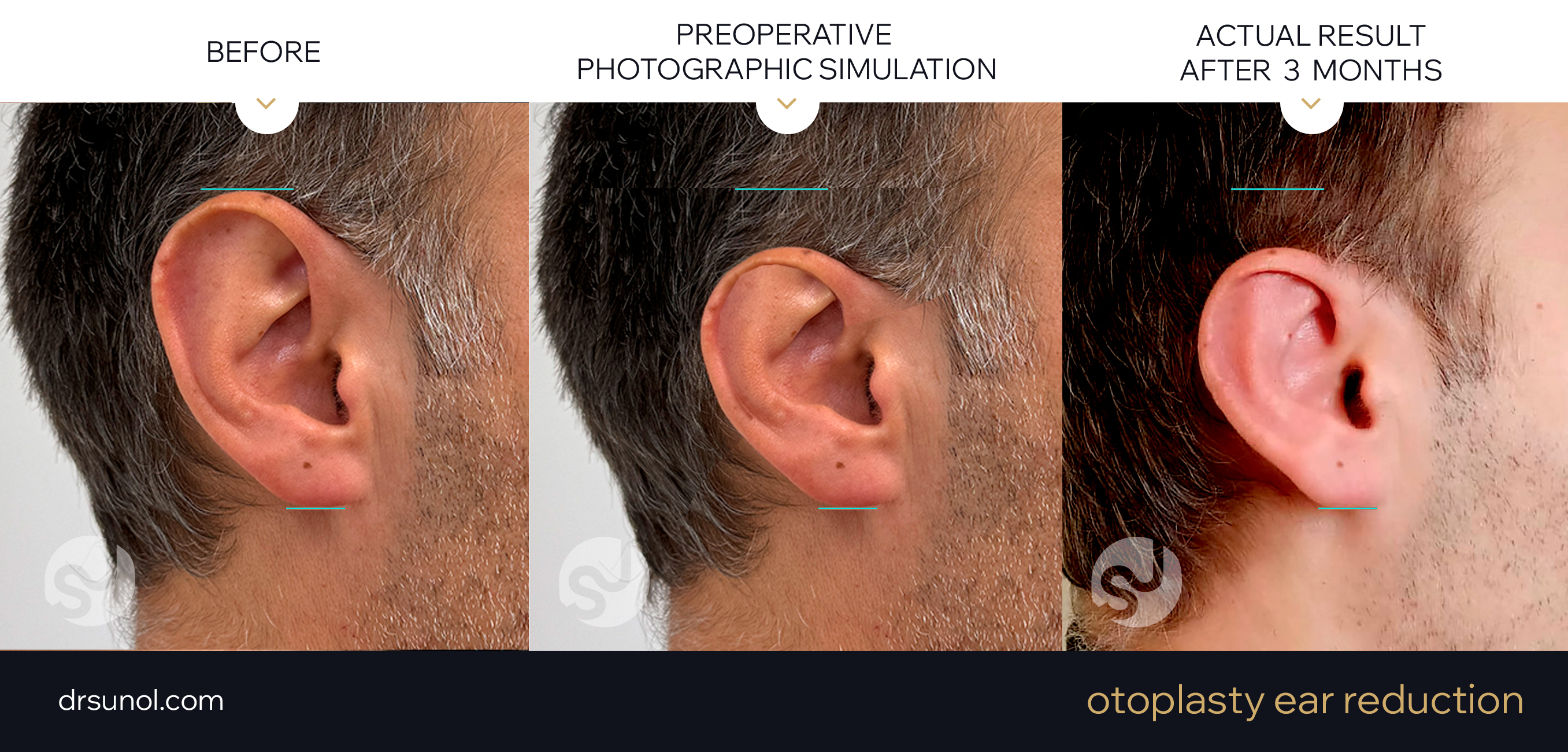 PreOp simulation of ear reduction surgery and real results after 3 months