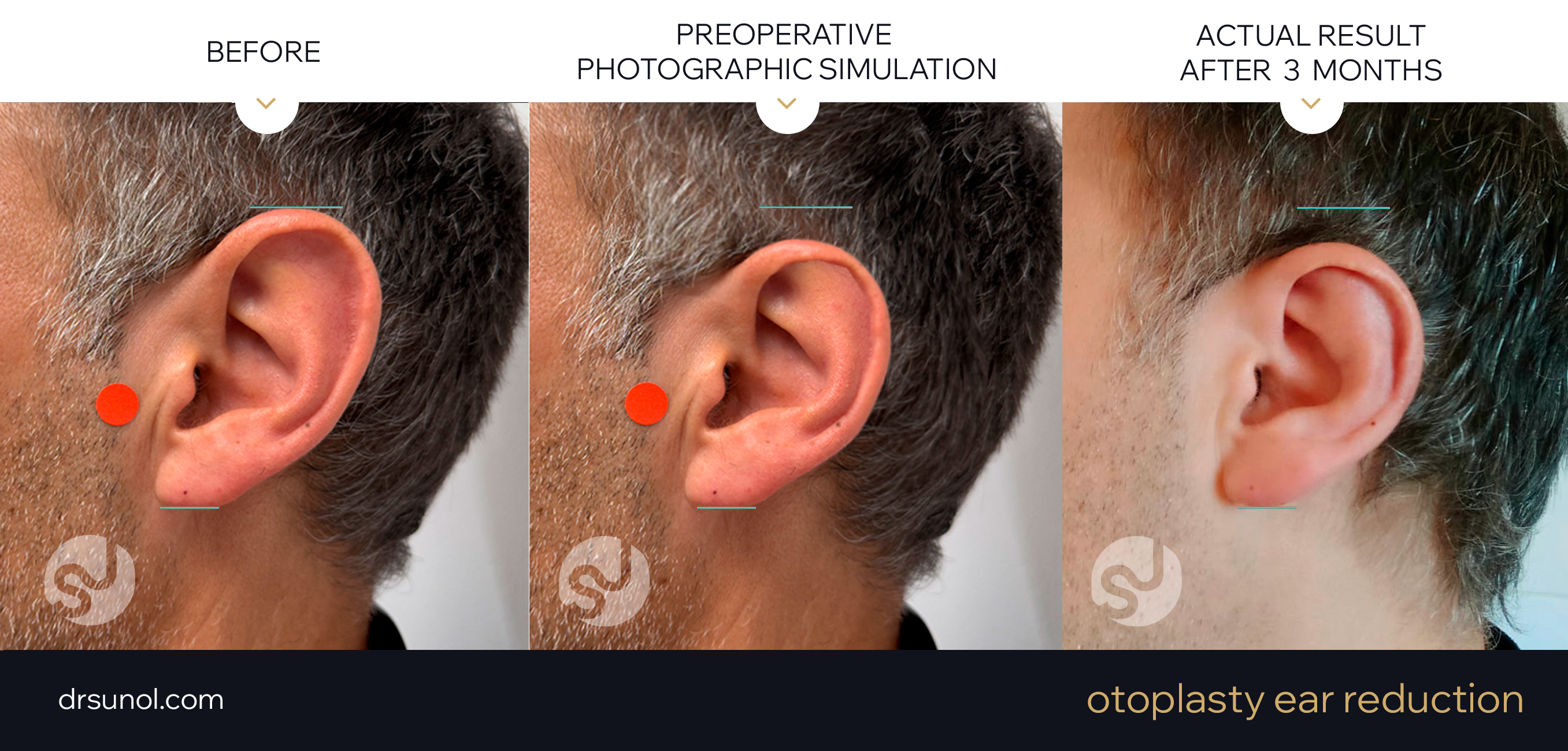 PreOp, simulation of ear reduction surgery and real result after 3 months