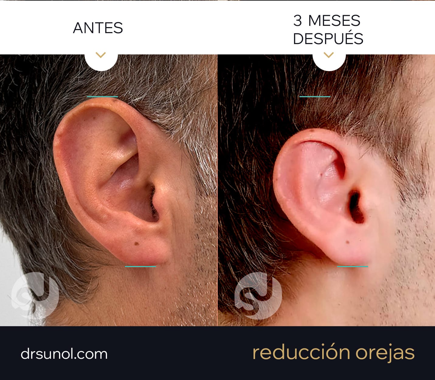 Cirugia de orejas grandes antes, simulacion y despues