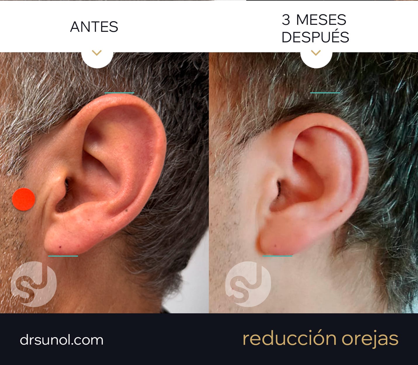 Otoplastia Reduccion tamaño antes, simulacion y despues