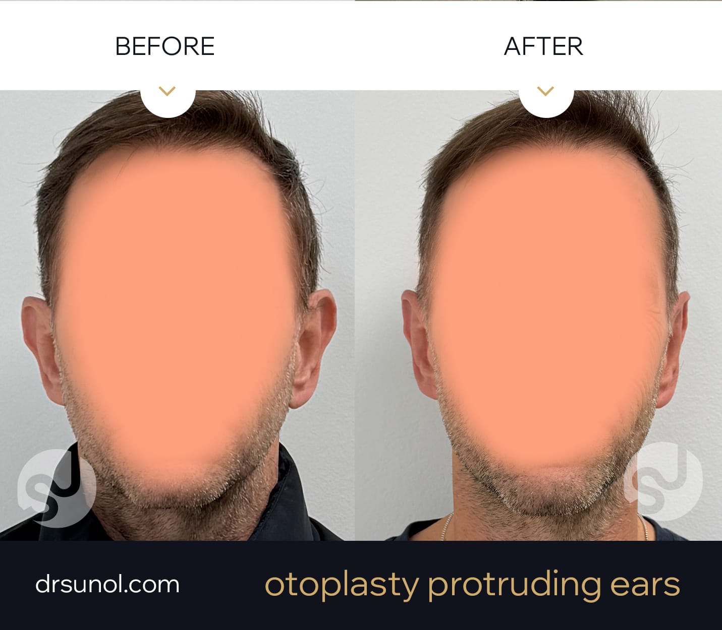 drsunolcom-patient-97 Otoplasty Protruding Ears Before After