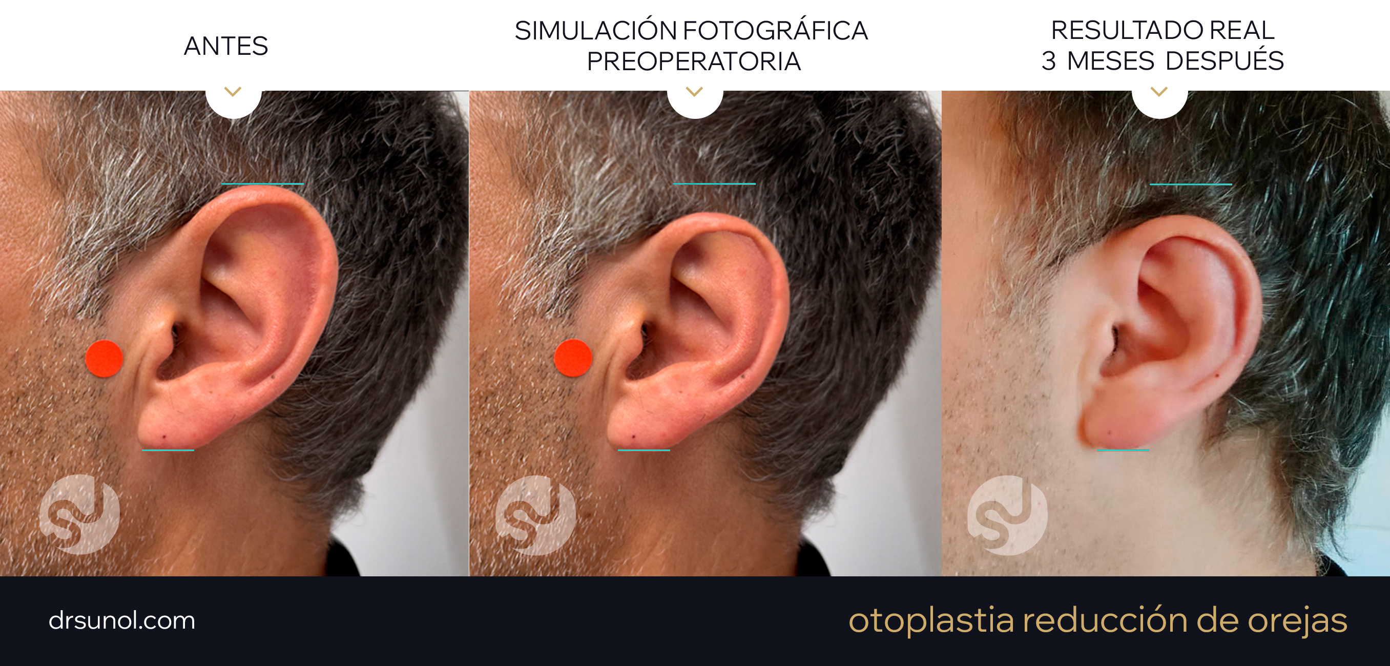 Antes, Simulación fotográfica y resultados reales de Despues de reduccion de orejas
