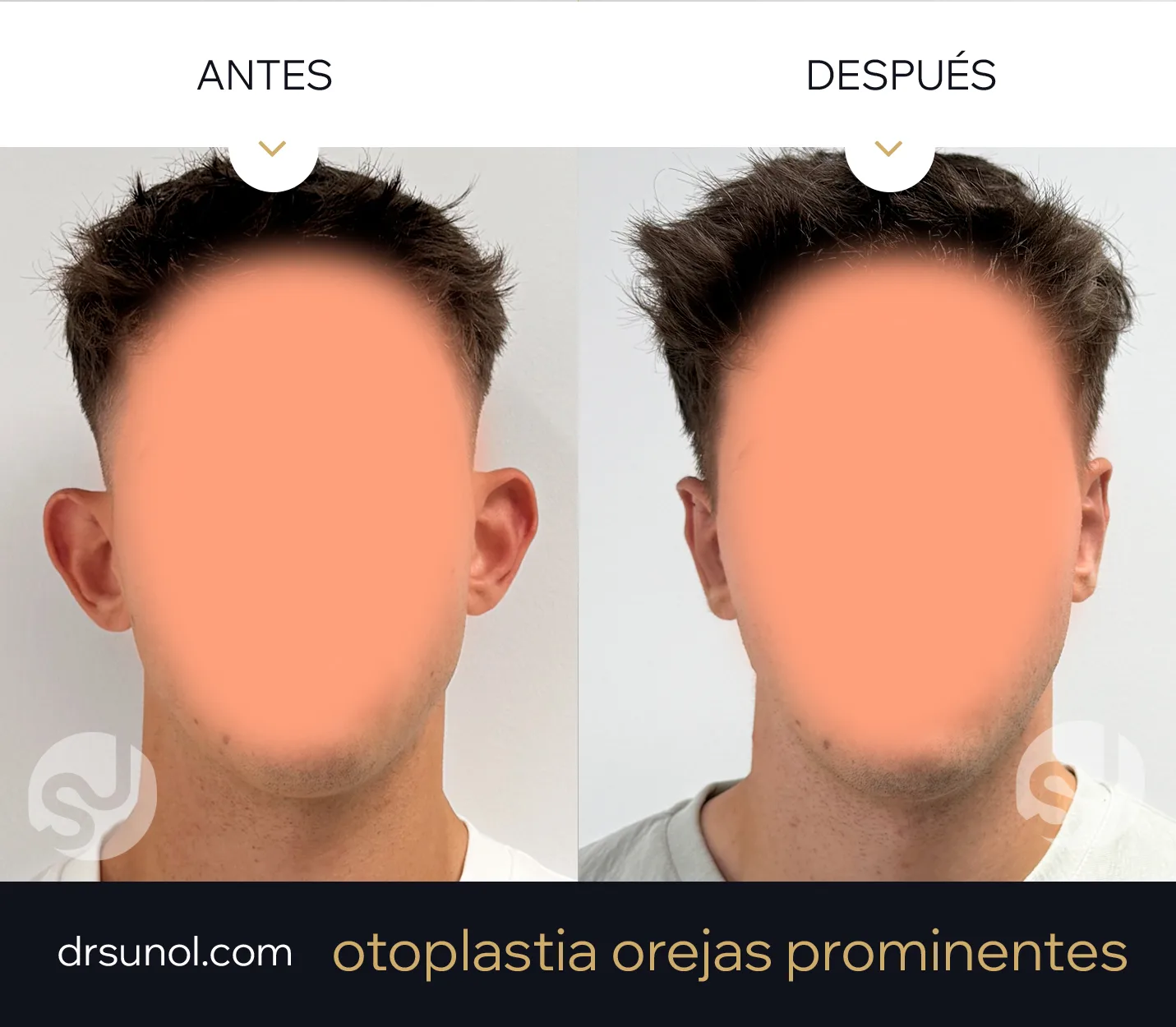 Otoplastia orejas de soplillo Otoplastia orejas de soplillo