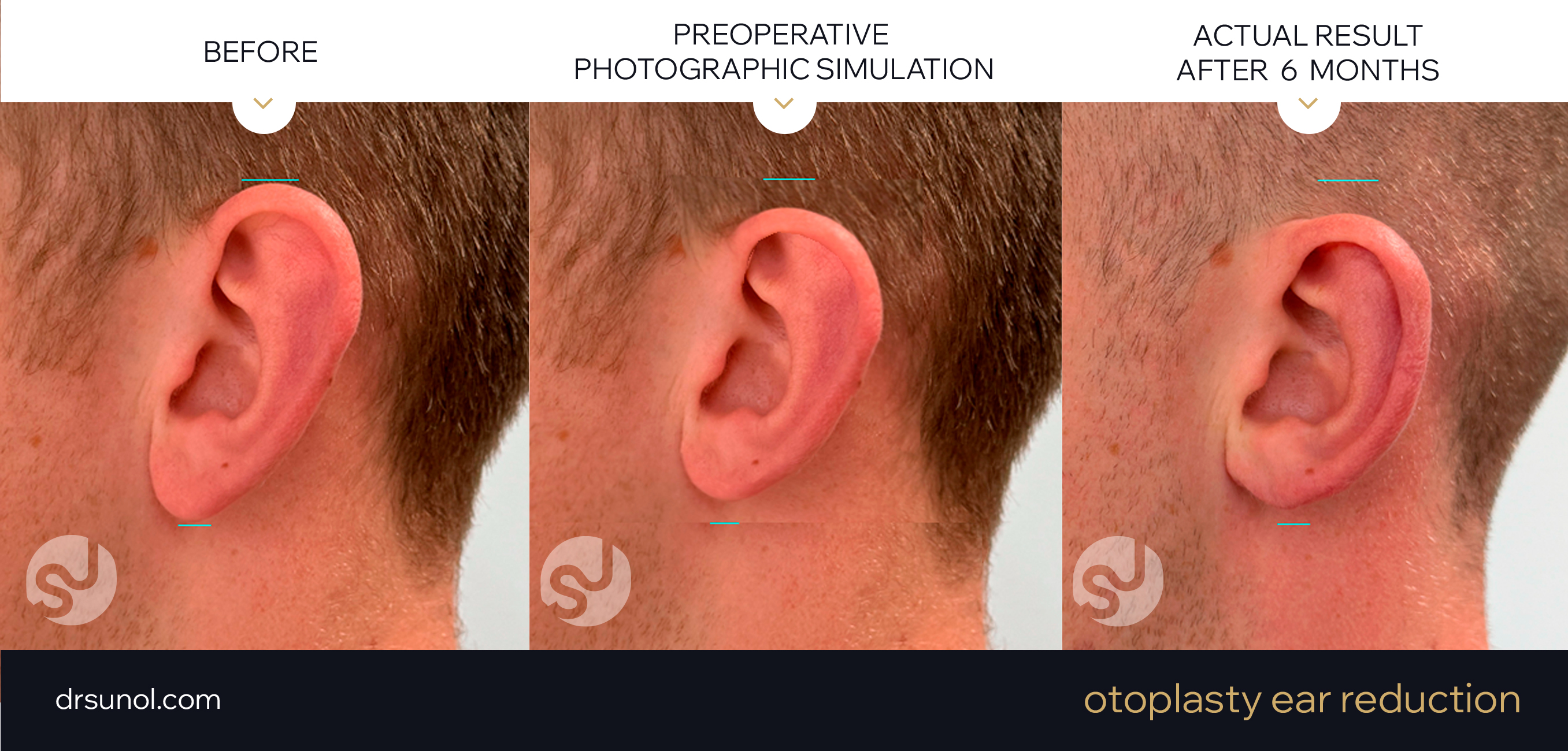 Ear Reduction Example of results before and after
