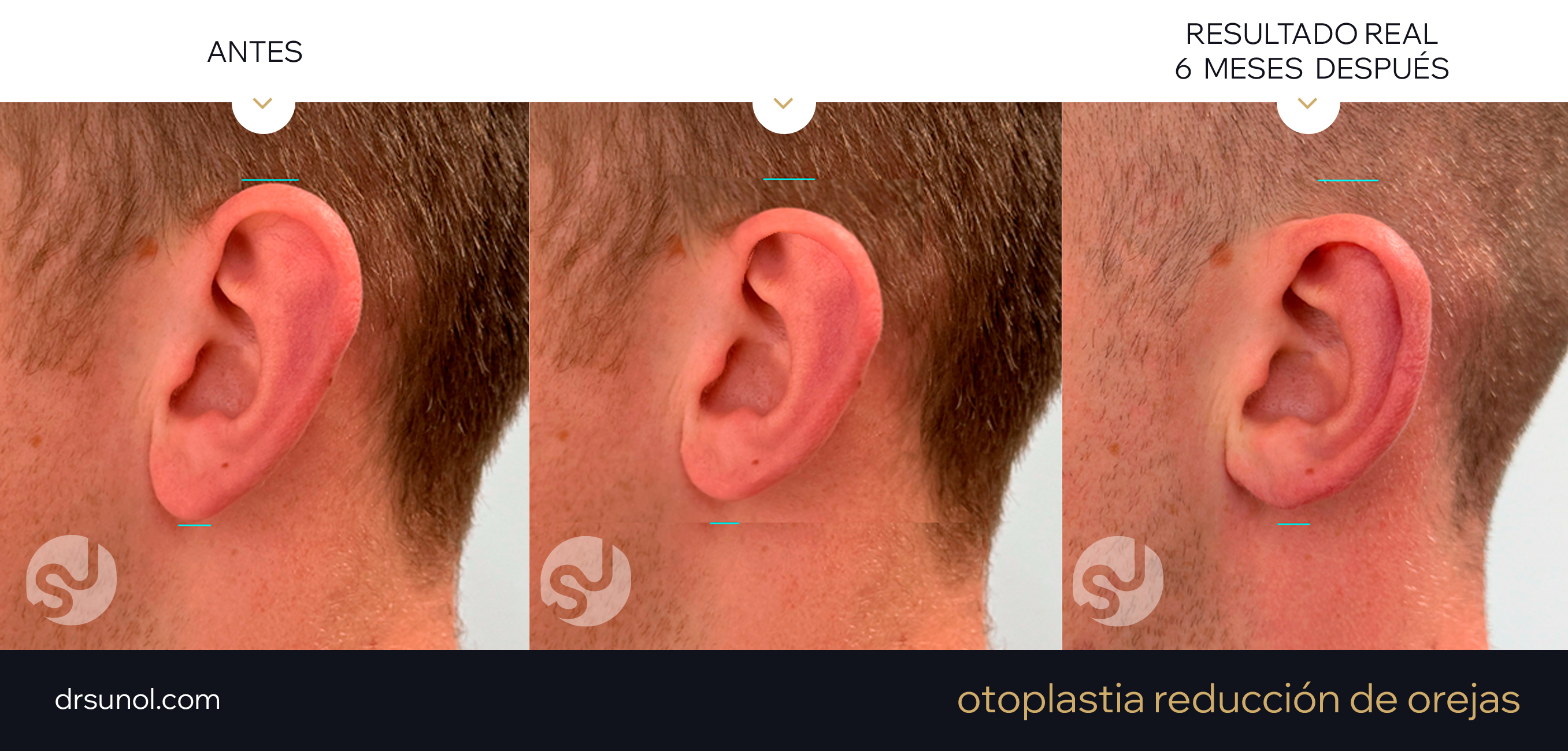 Reduccion de Orejas: Ejemplo de resultados (antes y despues)
