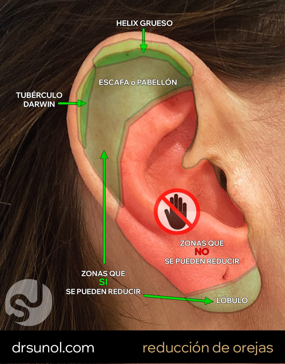 zonas que se pueden reducir en la otoplastia de reduccion