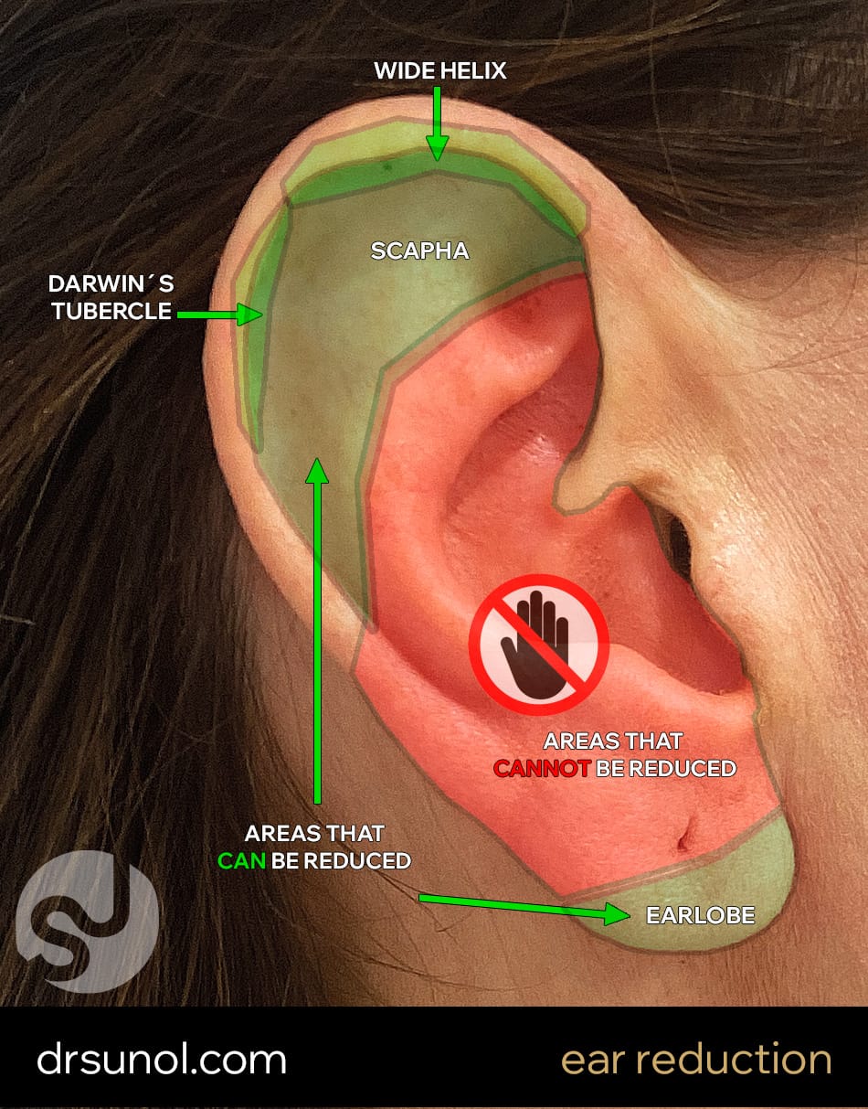 zones that can be reduced in Ear Reduction Otoplasty