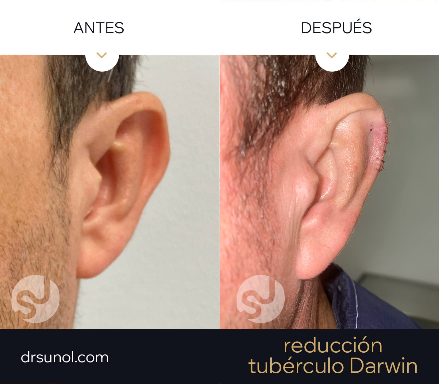 MiniOtoplastia orejas prominentes tuberculo darwin MiniOtoplastia orejas prominentes tuberculo darwin width=