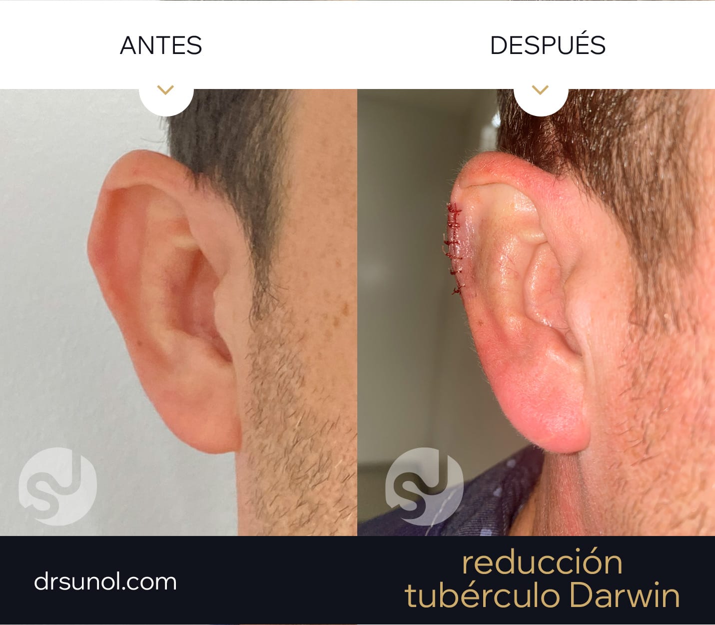 MiniOtoplastia orejas prominentes tuberculo darwin MiniOtoplastia orejas prominentes tuberculo darwin width=