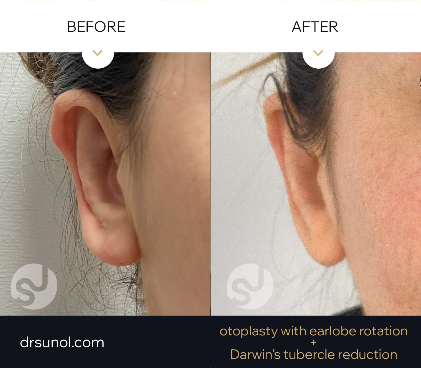 Otoplastia Reduccion tuberculo Darwin y rotacion lobulos oreja Otoplastia Reduccion tuberculo Darwin y rotacion lobulos oreja