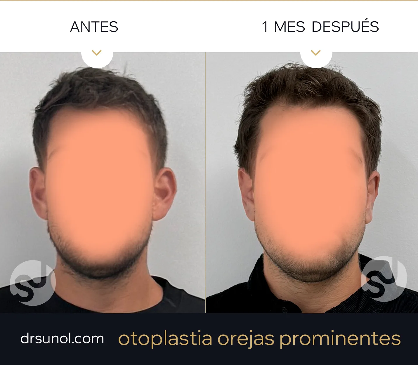 Vista de Perfil orejas de soplillo antes y después Vista de Perfil orejas de soplillo antes y después