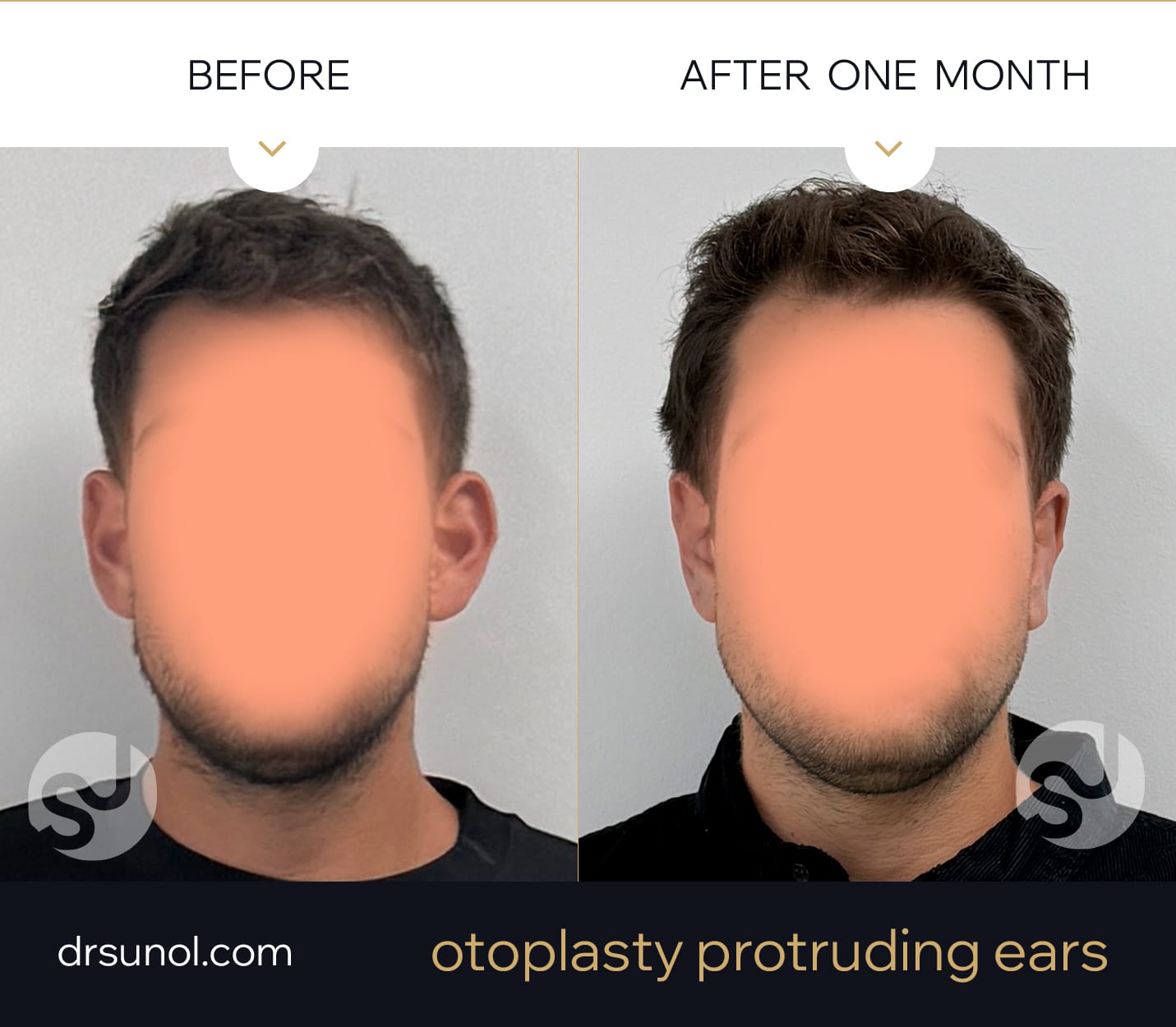 protruding ears before and after