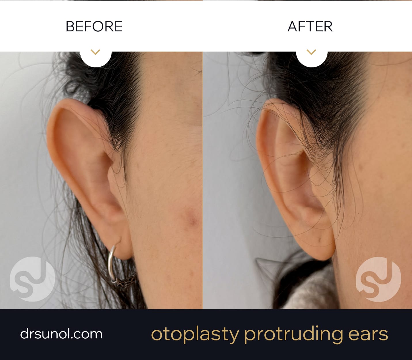 drsunolcom-patient-112 Ear Pinning Otoplasty Before After