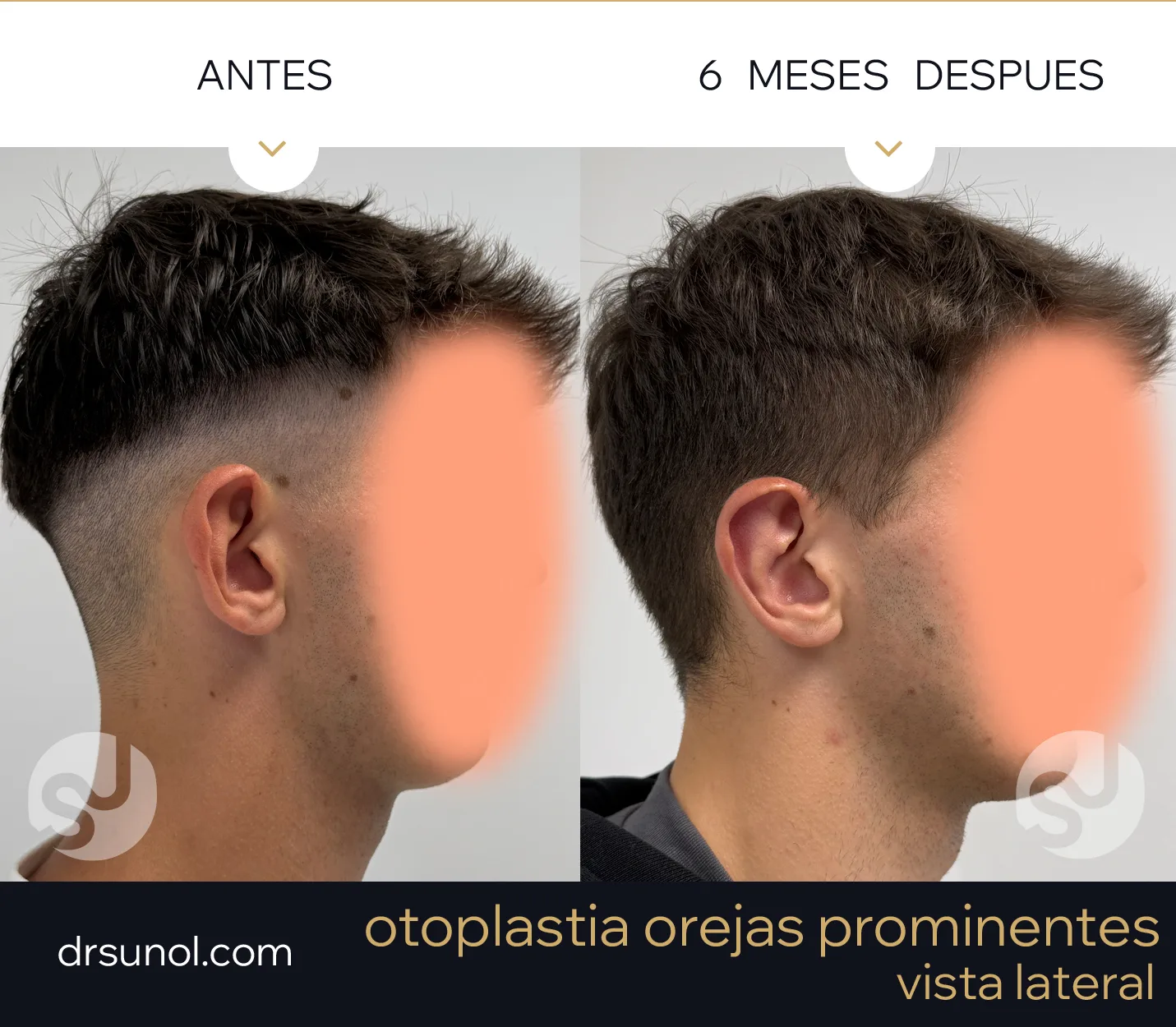 Vista de Perfil orejas de soplillo antes y después Vista de Perfil orejas de soplillo antes y después