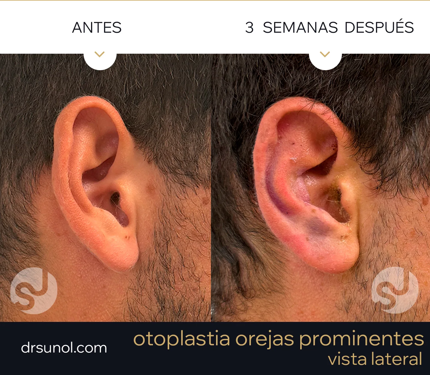 Vista de Perfil orejas de soplillo antes y después Vista de Perfil orejas de soplillo antes y después