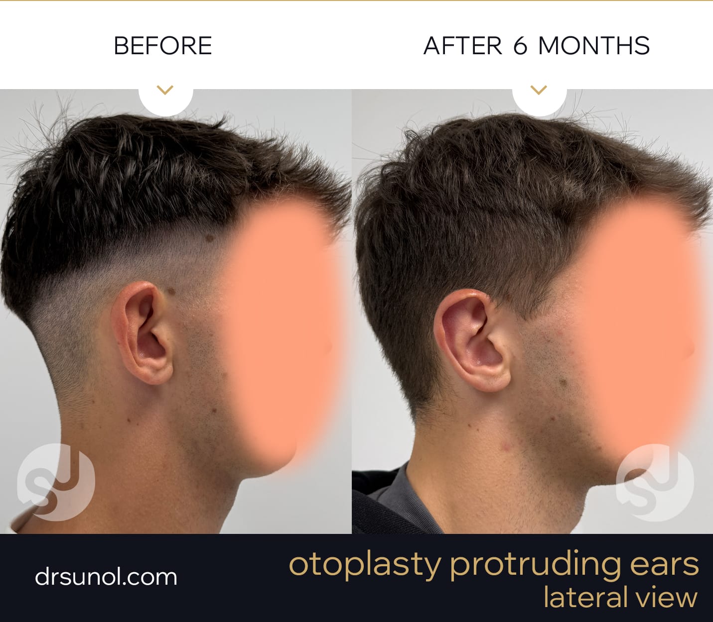 protruding ears before and after