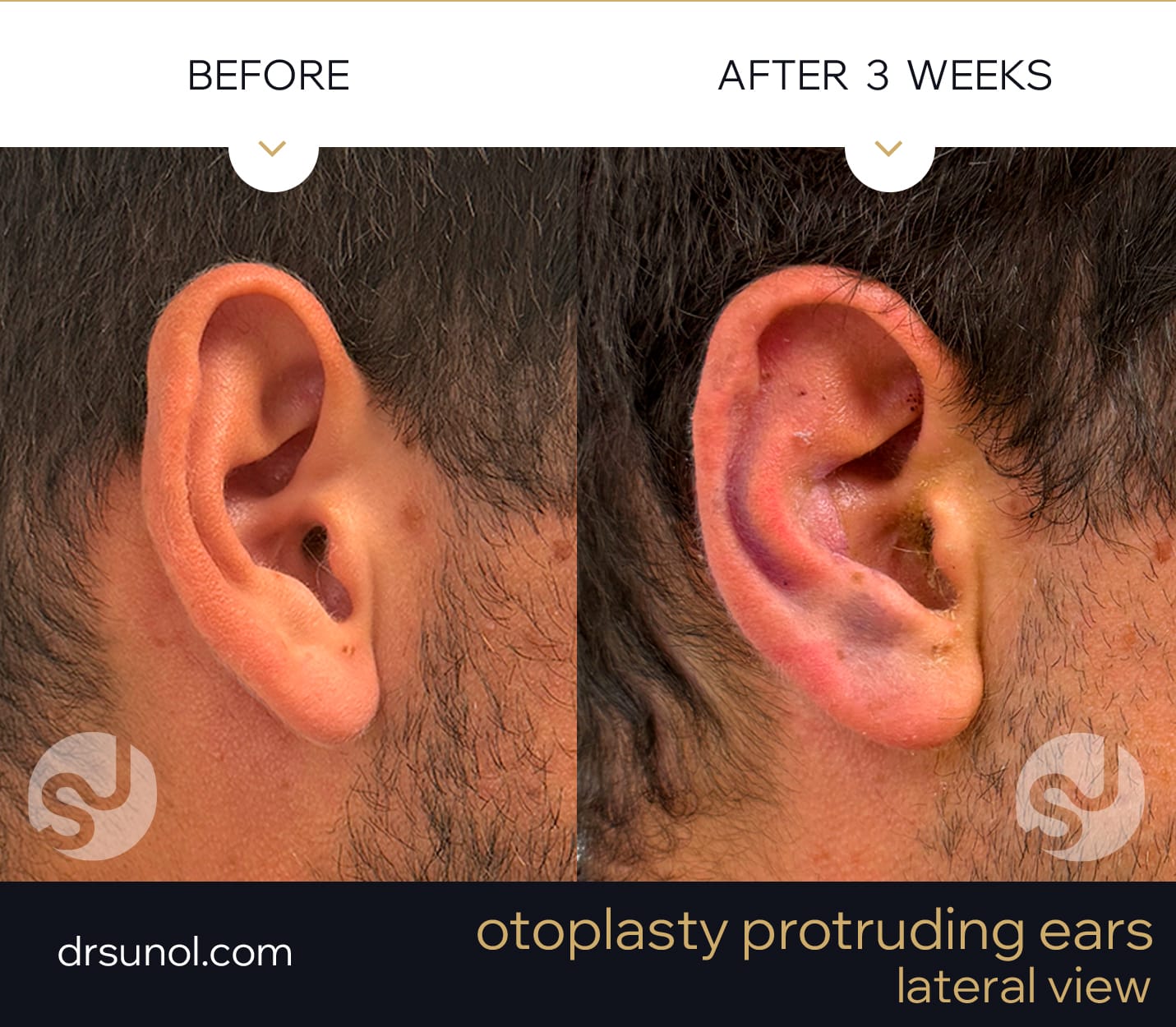 protruding ears before and after