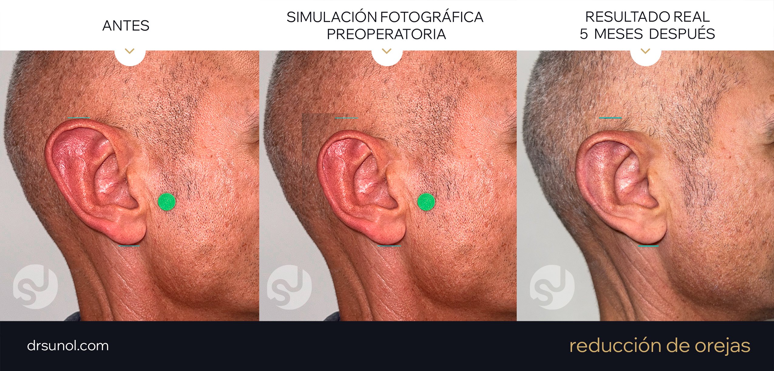 Reduccion de Orejas: Ejemplo de resultados (antes y despues)