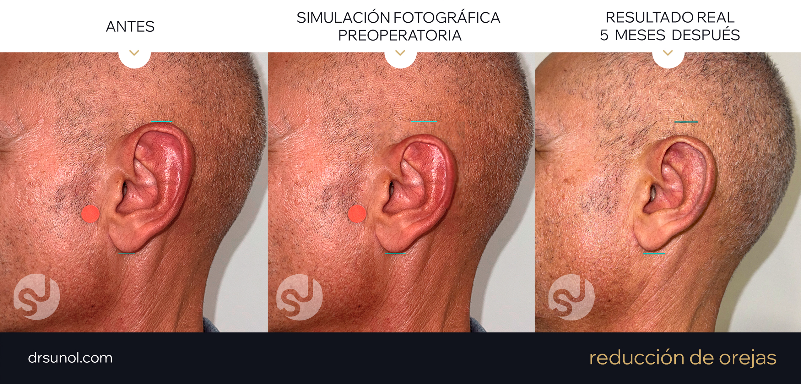 Reduccion de Orejas: Ejemplo de resultados (antes y despues)