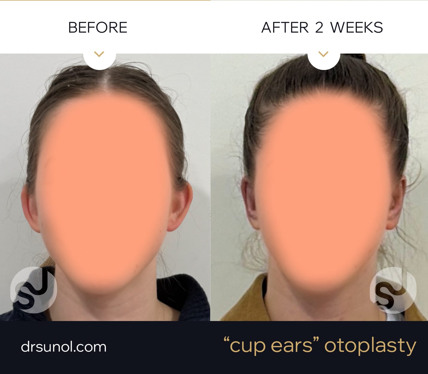 Cup Ears Otoplasty Cup Ears Otoplasty