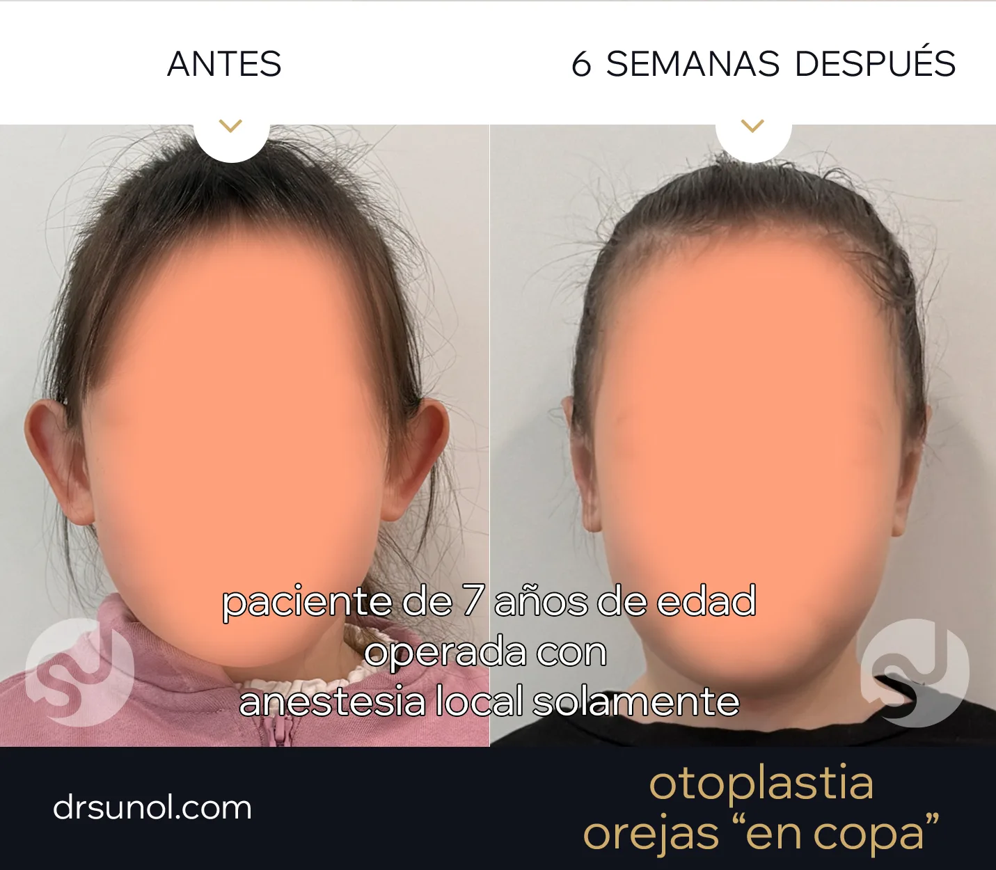 Operacion Orejas en copa en niños con anestesia local solamente Operacion Orejas en copa en niños con anestesia local solamente