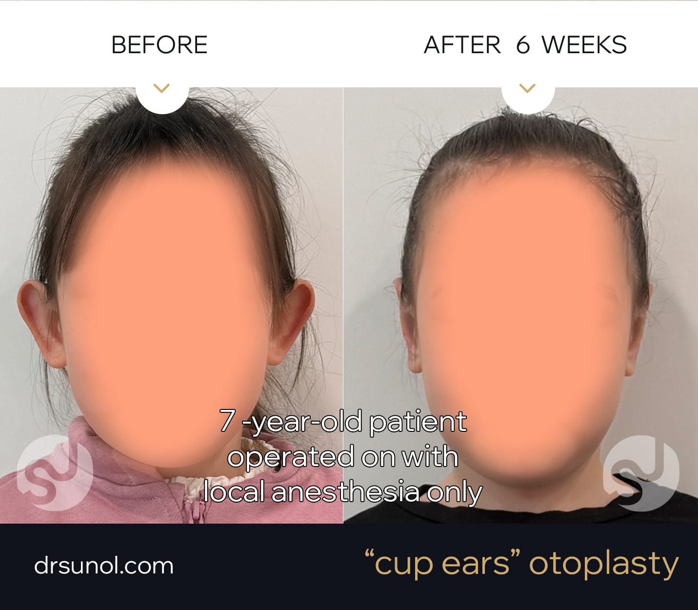 Cup ears pinning surgey on children with local anesthesia only Cup ears pinning surgey on children with local anesthesia only